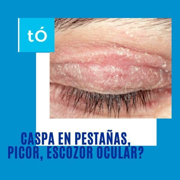 CASPA EN LAS PESTAÑAS